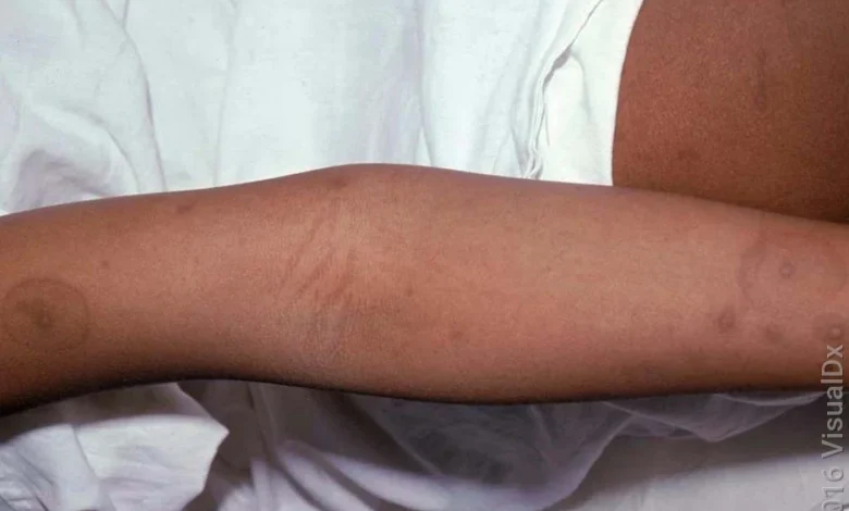 chicken pox on black skin